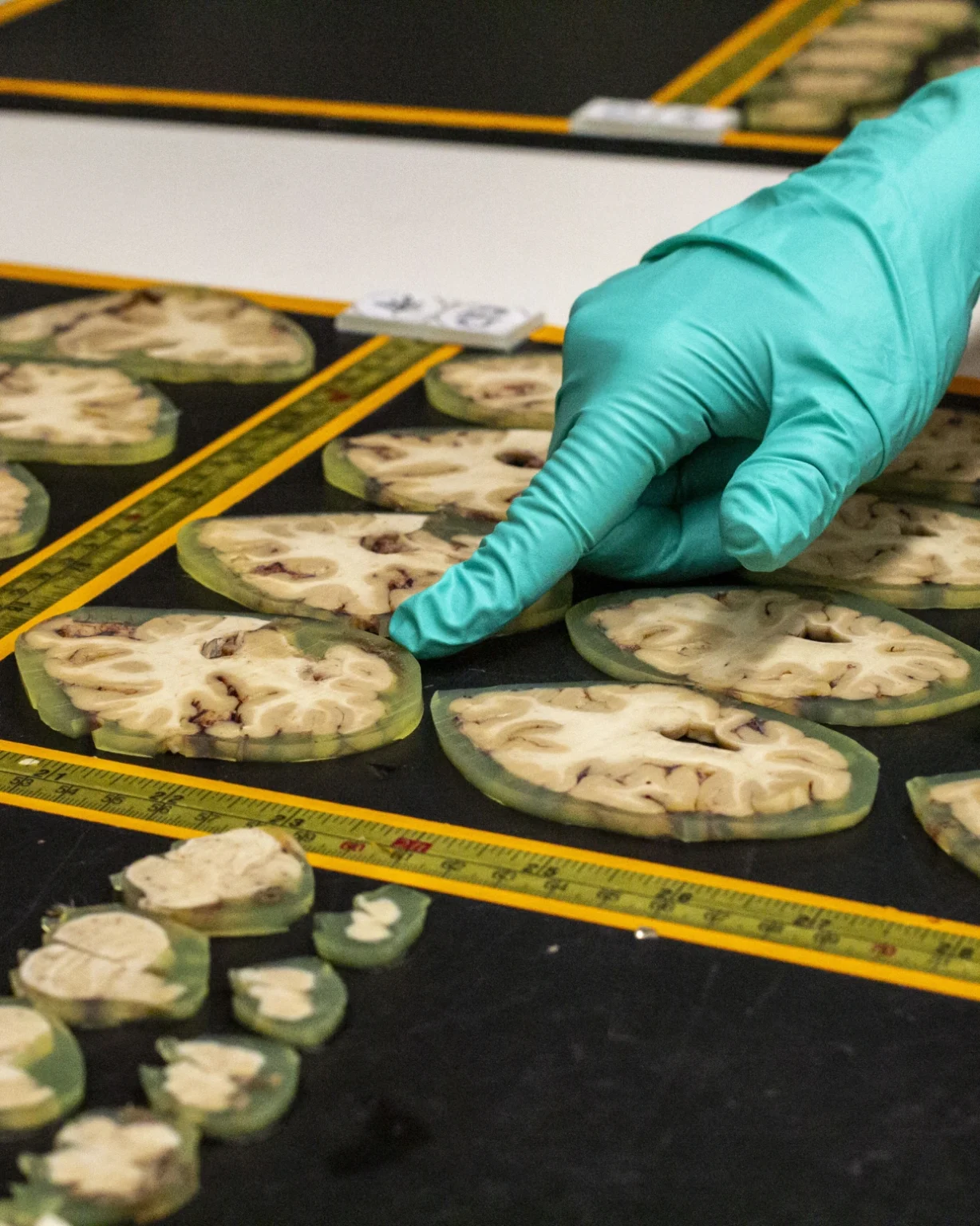 Four-millimeter slices of brain are preserved and embedded in a gel called agarose at Harborview Medical Center in Seattle. Researchers arrange slices of brain in sequences from front to back, so they can identify markers of Alzheimer’s or other neurodegenerative diseases. Evan Bush / NBC News